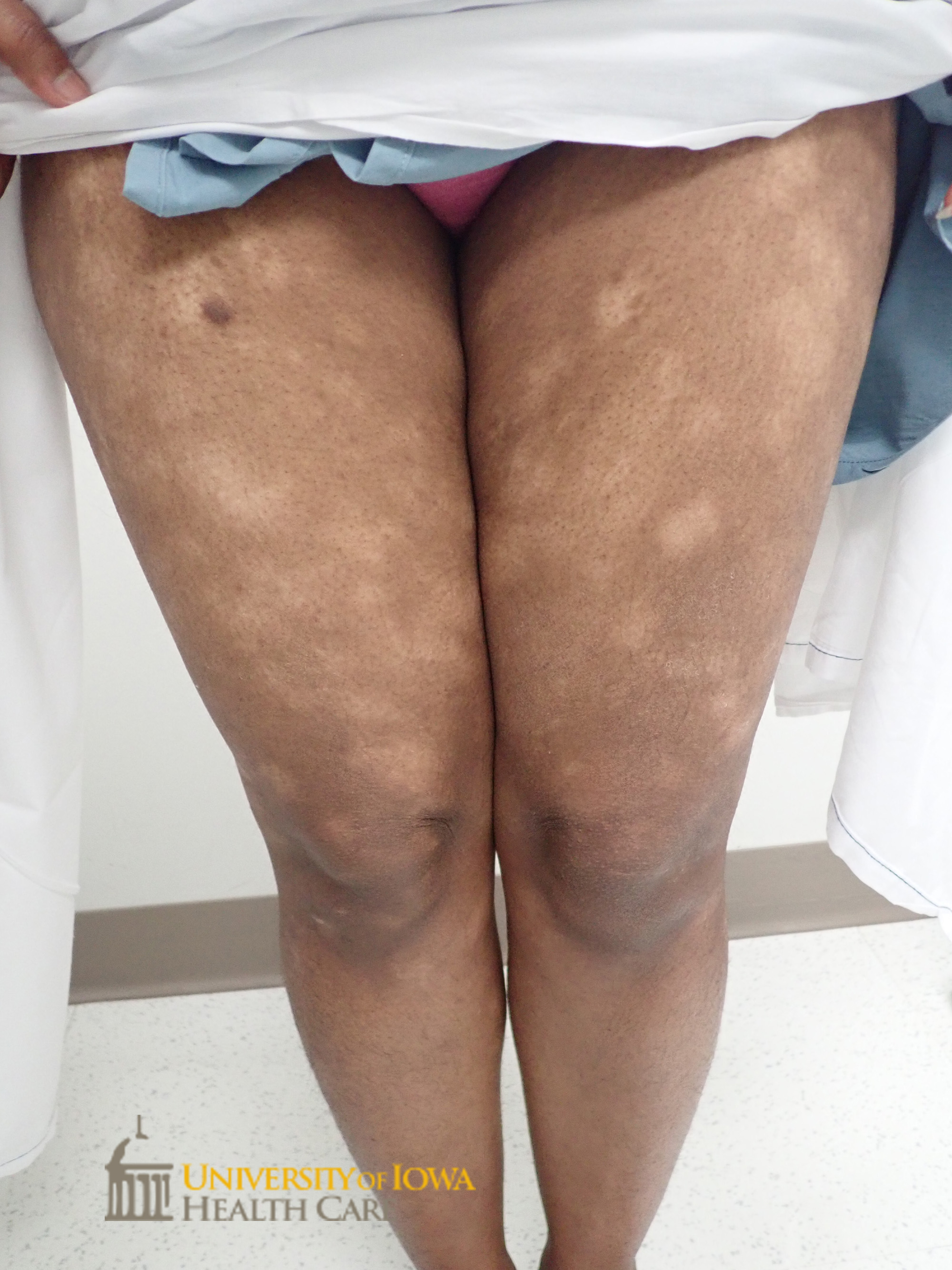Annular hypopigmented patches on the thighs. (click images for higher resolution).